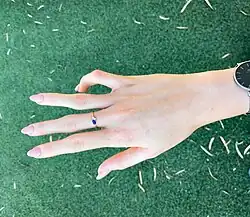 A palm of a young woman with the Beals Hecht syndrome