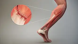 3D Medical Animation Depicting Strain
