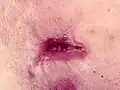 Treated wound healing