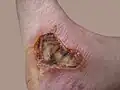 Eight day old third-degree burn caused by motorcycle muffler.