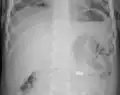 AP X ray showing a 9V battery in the intestines
