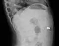 Lateral X ray showing a 9V battery in the intestines