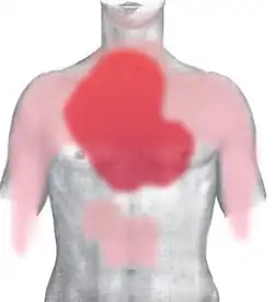 Pain in acute myocardial infarction
