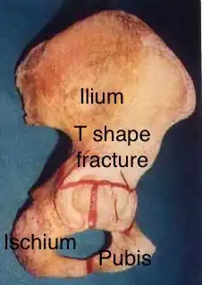 T shape fracture shown on bone model