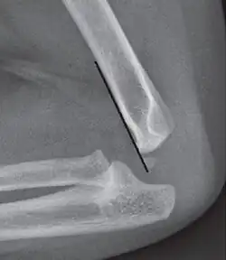The anterior humeral line is not reliable in children with sparse ossification of the capitulum, such as in this 6 months old child.[11]