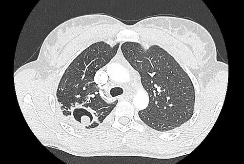 Cavity in the lung containing a simple aspergilloma.