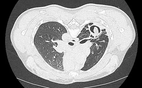 Cavity in the lung with an aspergilloma.