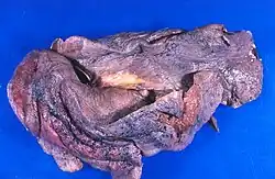 An image of a harvested human lung against a blue background. The dark shriveled with dense tissue indicates total lung collapse. Inflammation is also visible.