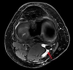 Baker's cyst on axial MRI with communicating channel between the semimembranosus muscle and the medial head of the gastrocnemius muscle