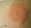 A bee sting 1 day after