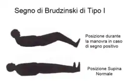 Illustration of "Brudzinski Sign Type I"