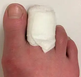 second and third toes wrapped in padding and a bandage, leaving the big toe free