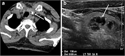 CT (L) and ultrasound (R) of thyroid colloid nodule with calcification[17][11]