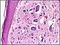 Histopathology of calcinosis cutis in human tissue