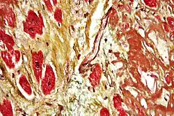 Microsopic view of heart tissue colored by Movat's stain. Muscle tissue stained red, collagen stained yellow and amyloid stained brown.