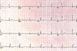 RBBB