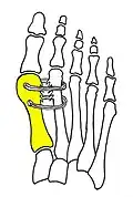 Cerclage bone sutures