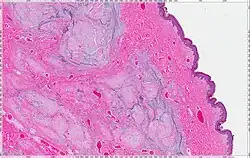 Cutaneous Myxoma