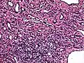 High power view showing a vascular tumor with cuboidal endothelium lining the vessels. Few entrapped seminiferous tubules are also noted (arrow).