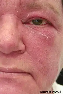 Facial rash