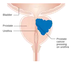 Cross-section diagram of prostate with urethra running through centrally. A large mass within the prostrate compresses the urethra.