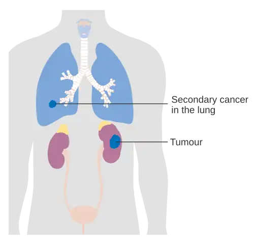 Stage 4 kidney cancer