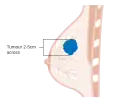 Stage T2 breast cancer