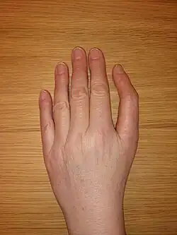 Thumb malformation that sometimes accompanies DBA