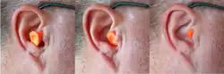 Three photographs of an ear with earplugs inserted into them