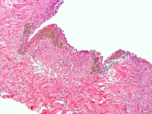 Microscope image of the wall of an endometrioma. All features of endometriosis are present (endometrial glands, endometrial stroma and iron in macrophages)