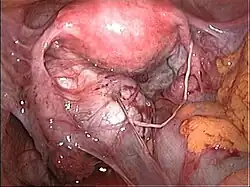 White stringy adhesions associated with deep endometriosis