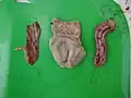 PM lesions on proventriculus, gizzard, and duodenum