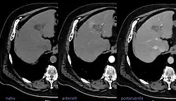 Example of multi-phase contrast-enhanced CT scan of the liver, which is used for LIRADS criteria.