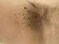 Skin tags (acrochordons), which may accompany endocrine-associated AN