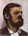 Lupus vulgaris in a man, c. 1900
