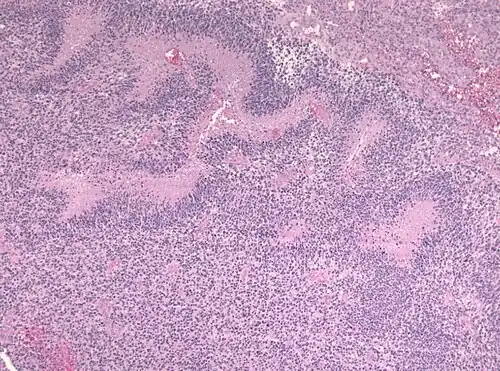 Pseudopalisading seen around necrosis in glioblastoma