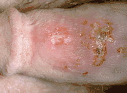 Genital herpes in a male, showing vesicles, ulcers, and crusts on the penis.