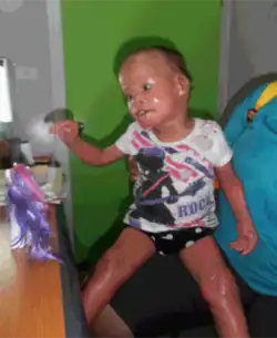 Harlequin ichthyosis in a three-year-old girl, the keratin scales having almost completely fallen off