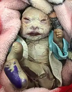An infant with harlequin ichthyosis