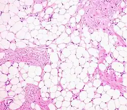 Histopathology of a lipoma: The mass is composed of lobules of mature white adipose tissue divided by fibrous septa containing thin-walled capillary-sized vessels.[25][predatory publication] H&E stain.