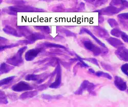 Small cell carcinoma is a cancer where the presence of smudging is a clue to the diagnosis.[5]