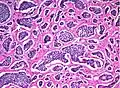 Carcinoid