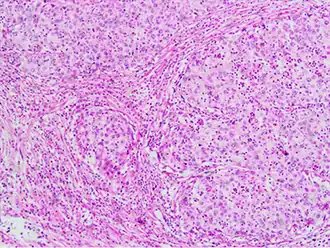 Invasive squamous cell carcinoma of the cervix is characterized by infiltration as irregular anastomosing nests or single cells.[74] This case is poorly differentiated. H&E stain.