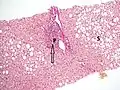 Histopathology of steatohepatitis with mild fibrosis in the form of fibrous expansion (Van Gieson's stain)[96]