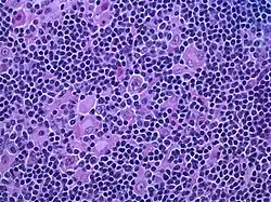 Hodgkin lymphoma, nodular lymphocyte predominant (high-power view): Notice the presence of L&H cells, also known as "popcorn cells" (H&E).