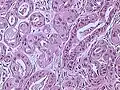 Invasive ductal carcinoma of the breast. H&E stain.
