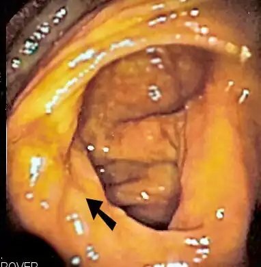 Endoscopic image of cecum with arrow pointing to ileocecal valve in foreground