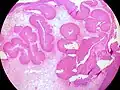 Inverted Schneiderian Papilloma of the Nasal Cavity.