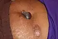Pedunculated umblical keloid