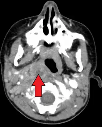 Large retropharyngeal abscess as seen on CT